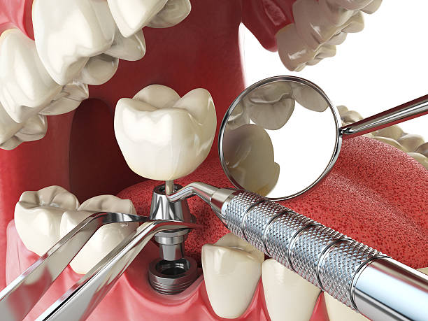 Best Emergency Dental Care for Broken or Chipped Teeth in White Oak, MD